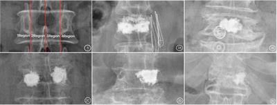 Effect of cement distribution type on clinical outcome after percutaneous vertebroplasty for osteoporotic vertebral compression fractures in the aging population